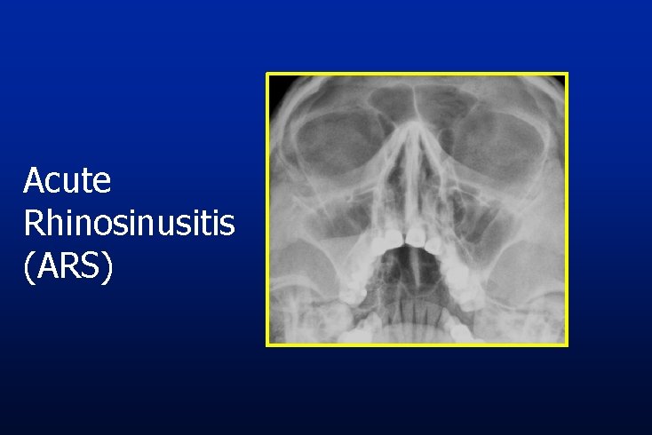 Acute Rhinosinusitis (ARS) 