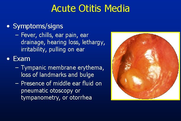 Acute Otitis Media • Symptoms/signs – Fever, chills, ear pain, ear drainage, hearing loss,