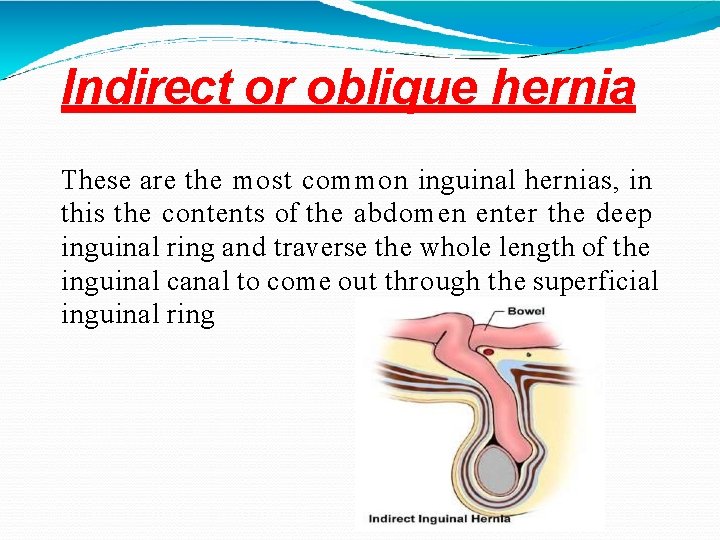 Indirect or oblique hernia These are the most common inguinal hernias, in this the
