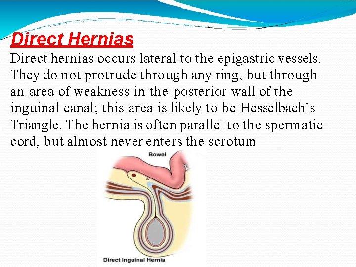 Direct Hernias Direct hernias occurs lateral to the epigastric vessels. They do not protrude