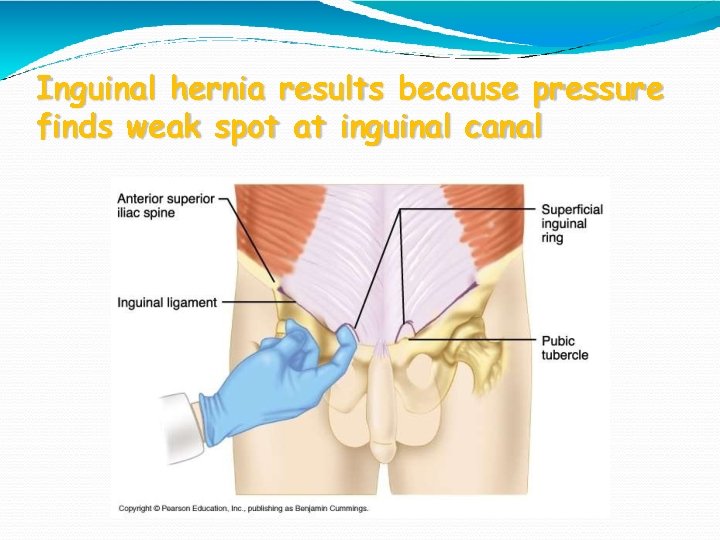 Inguinal hernia results because pressure finds weak spot at inguinal canal 