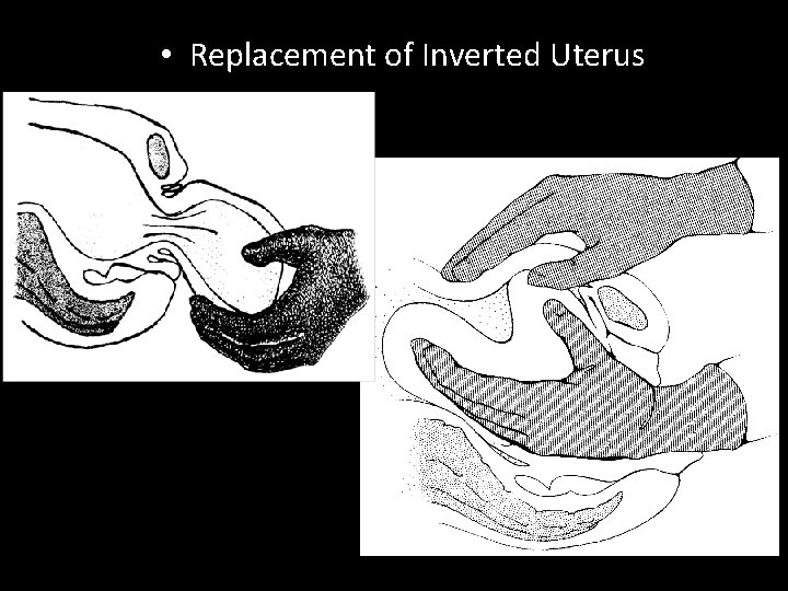• Replacement of Inverted Uterus • Replacement of Inverted Uterus