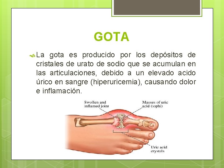 GOTA La gota es producido por los depósitos de cristales de urato de sodio