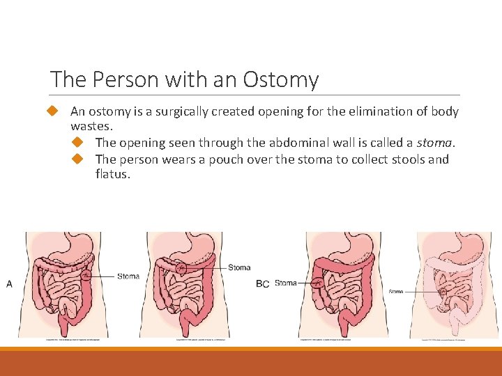 The Person with an Ostomy An ostomy is a surgically created opening for the