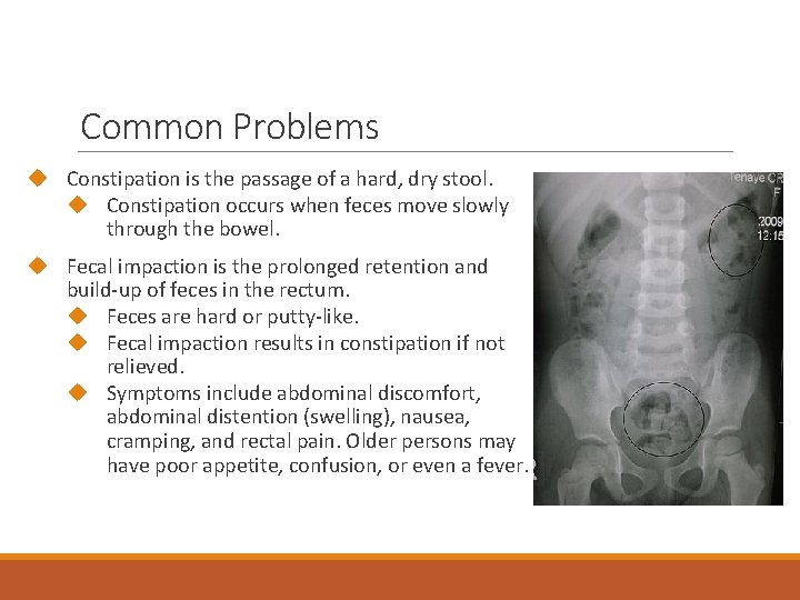 Common Problems Constipation is the passage of a hard, dry stool. Constipation occurs when