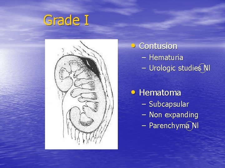 Grade I • Contusion – Hematuria – Urologic studies Nl • Hematoma – –