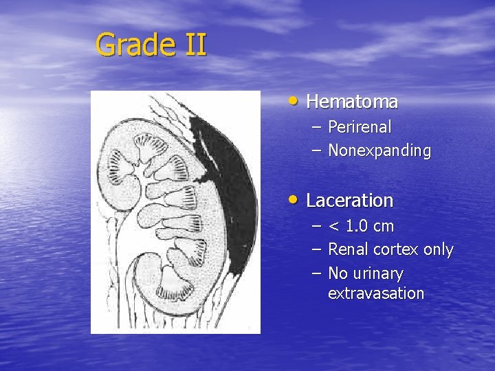 Grade II • Hematoma – Perirenal – Nonexpanding • Laceration – – – <
