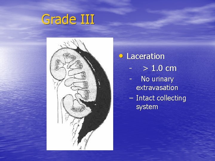 Grade III • Laceration - > 1. 0 cm No urinary extravasation – Intact