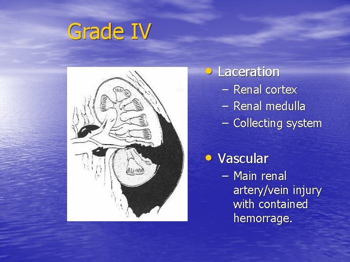 Grade IV • Laceration – – – Renal cortex Renal medulla Collecting system •