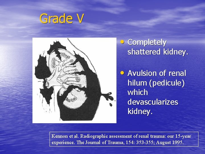 Grade V • Completely shattered kidney. • Avulsion of renal hilum (pedicule) which devascularizes