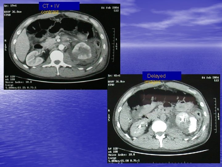 CT + IV contrast Delayed images 