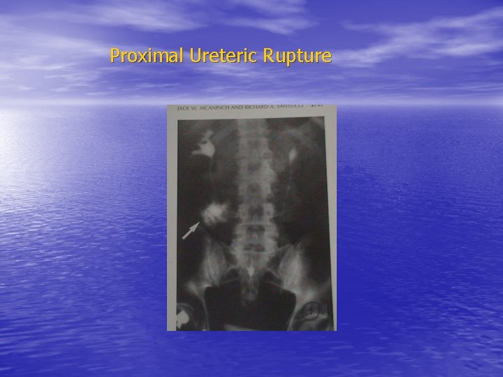 Proximal Ureteric Rupture 