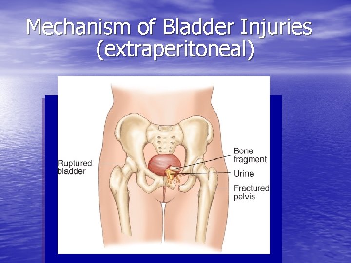Mechanism of Bladder Injuries (extraperitoneal) 