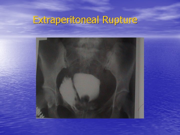 Extraperitoneal Rupture 