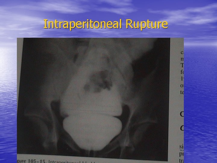 Intraperitoneal Rupture 
