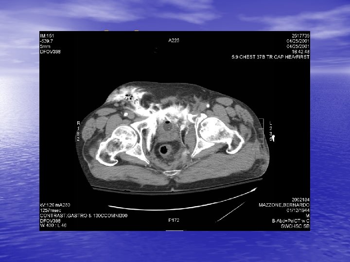 CT-Cystogram 