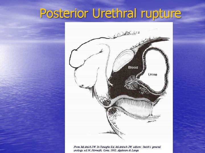 Posterior Urethral rupture From Mc. Anich JW. In Tanagho EA, Mc. Aninch JW, editors: