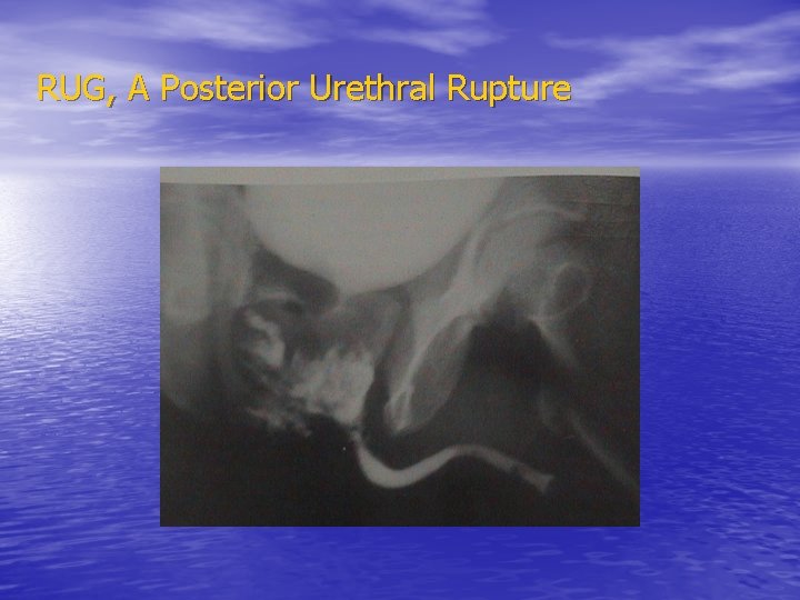 RUG, A Posterior Urethral Rupture 