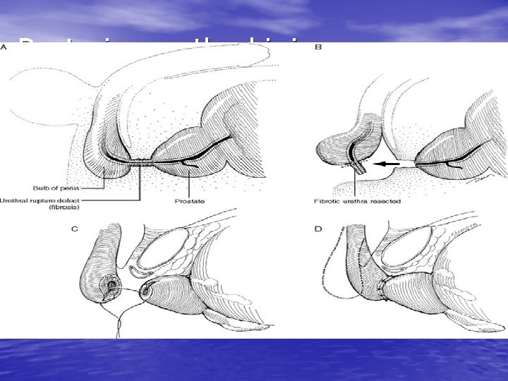 Posterior urethral injury 