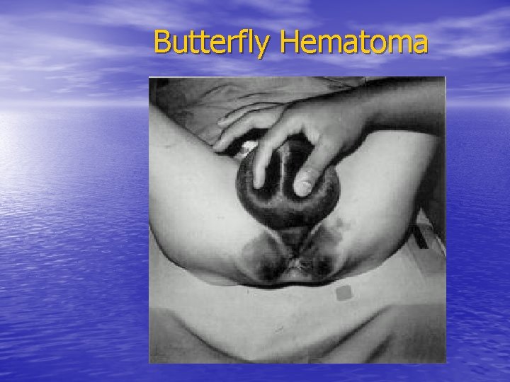Butterfly Hematoma 