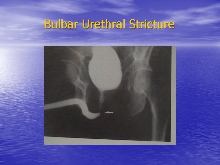 Bulbar Urethral Stricture 