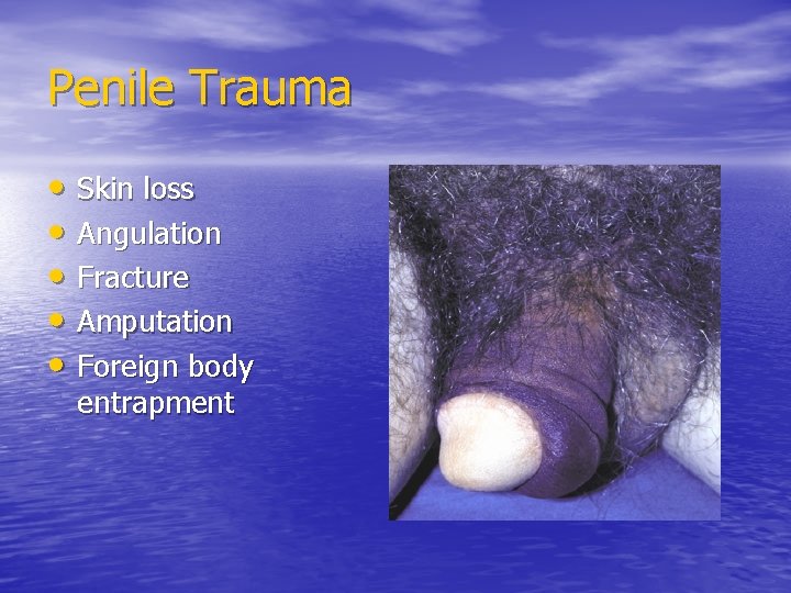 Penile Trauma • Skin loss • Angulation • Fracture • Amputation • Foreign body