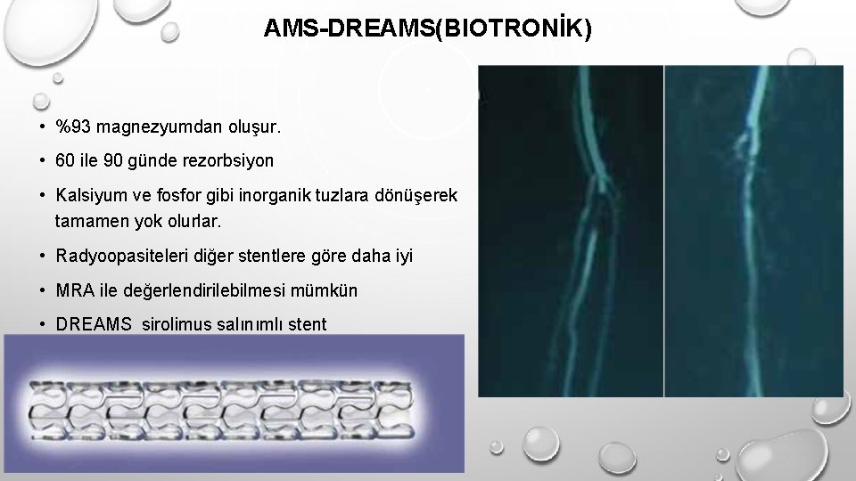 AMS-DREAMS(BIOTRONİK) • %93 magnezyumdan oluşur. • 60 ile 90 günde rezorbsiyon • Kalsiyum ve