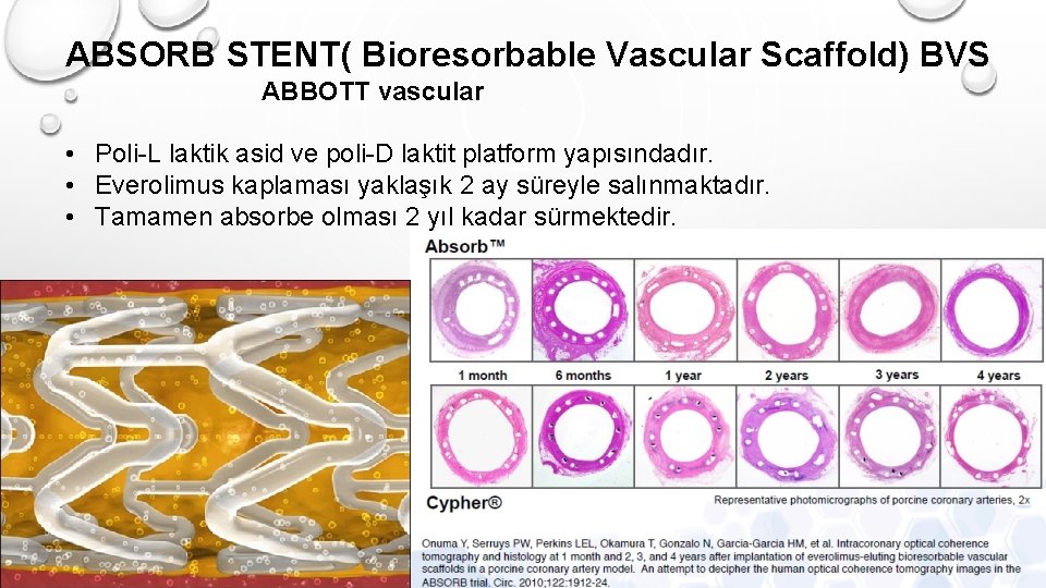 ABSORB STENT( Bioresorbable Vascular Scaffold) BVS ABBOTT vascular • Poli-L laktik asid ve poli-D