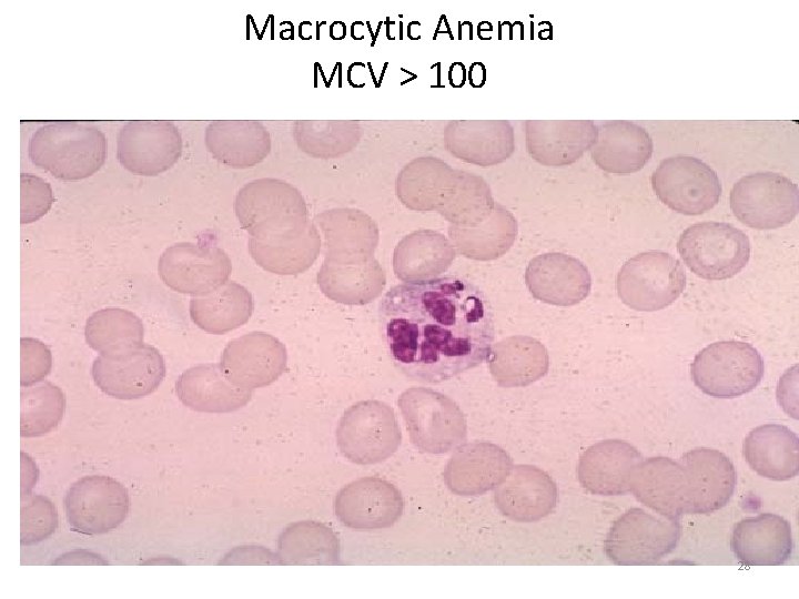 Macrocytic Anemia MCV > 100 28 