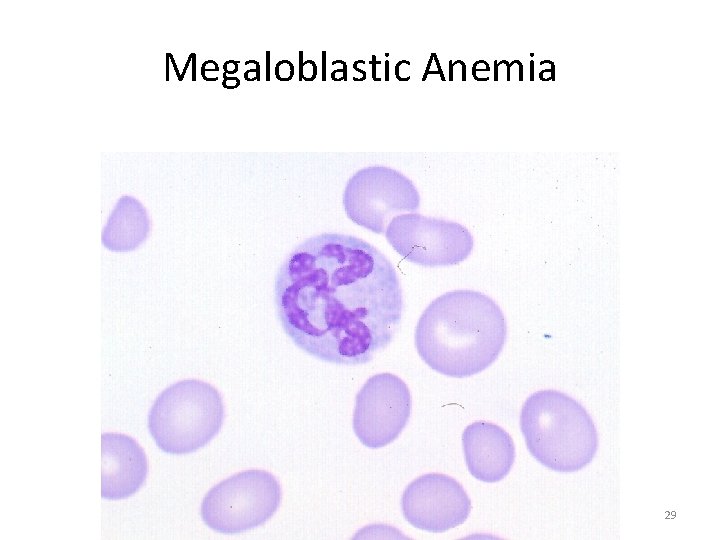 Megaloblastic Anemia 29 