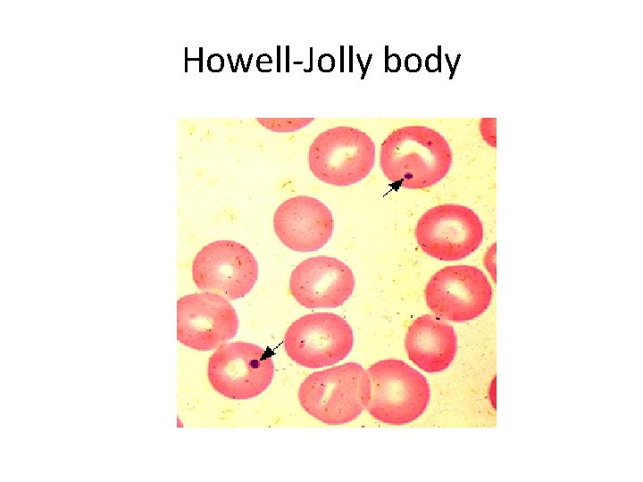 Howell-Jolly body 