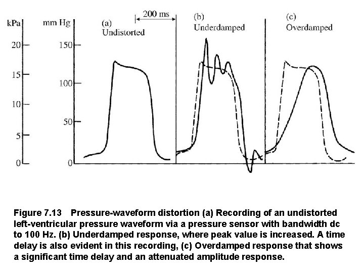 Figure 7. 13 Pressure waveform distortion (a) Recording of an undistorted left ventricular pressure waveform