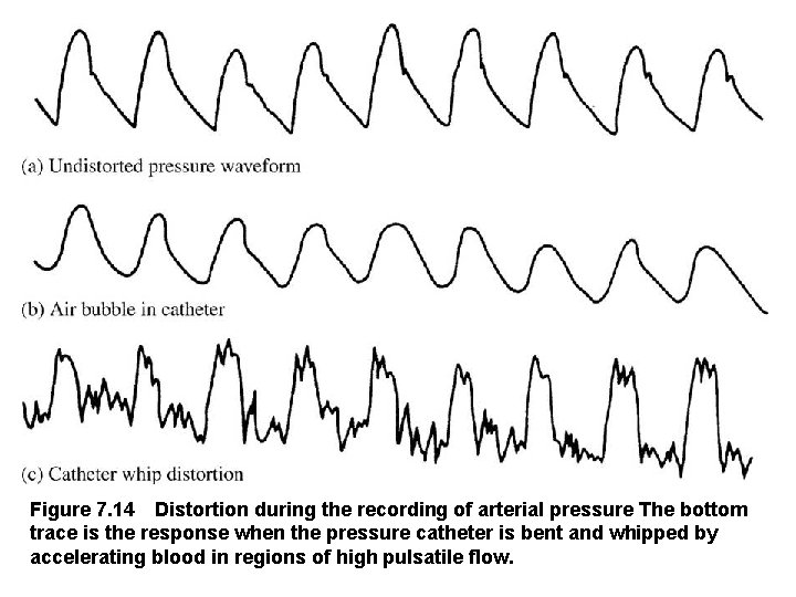 Figure 7. 14 Distortion during the recording of arterial pressure The bottom trace is the