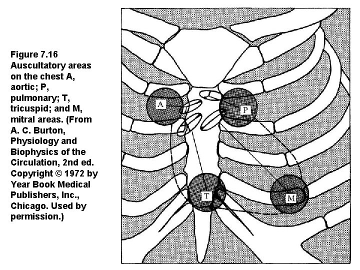Figure 7. 16  Auscultatory areas on the chest A, aortic; P, pulmonary; T, tricuspid;