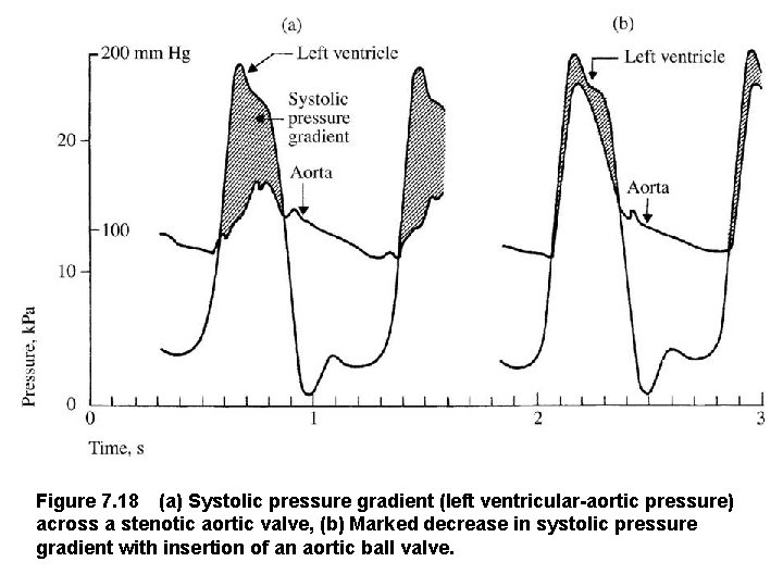 Figure 7. 18 (a) Systolic pressure gradient (left ventricular aortic pressure) across a stenotic aortic