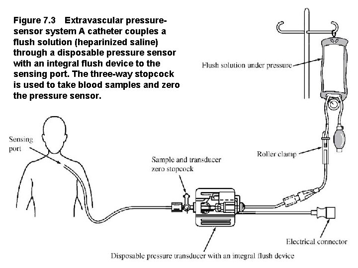Figure 7. 3 Extravascular pressure sensor system A catheter couples a flush solution (heparinized saline)