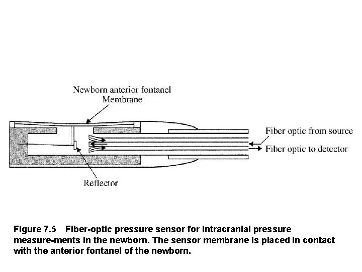Figure 7. 5 Fiber optic pressure sensor for intracranial pressure measure ments in the newborn.