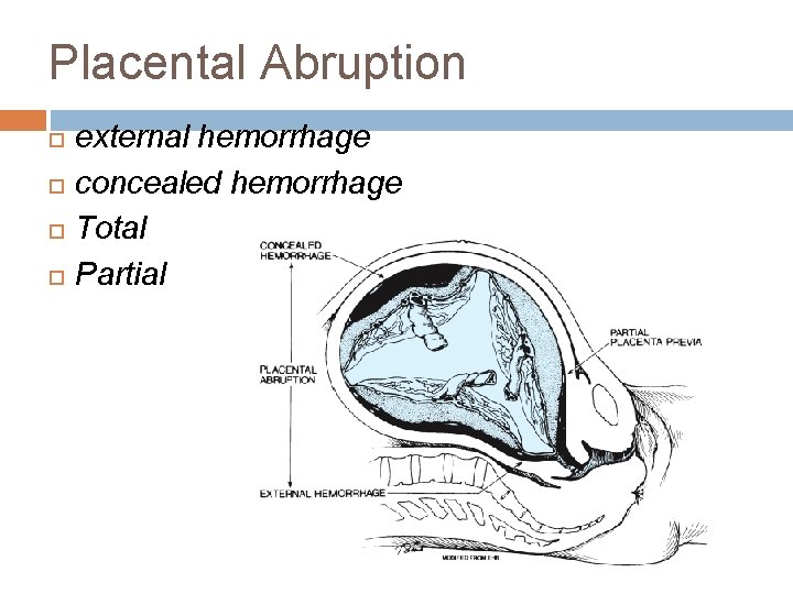 Placental Abruption external hemorrhage concealed hemorrhage Total Partial 