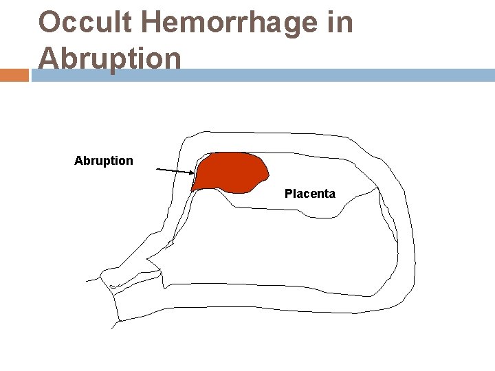 Occult Hemorrhage in Abruption Placenta 