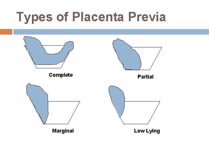 Types of Placenta Previa Complete Marginal Partial Low Lying 