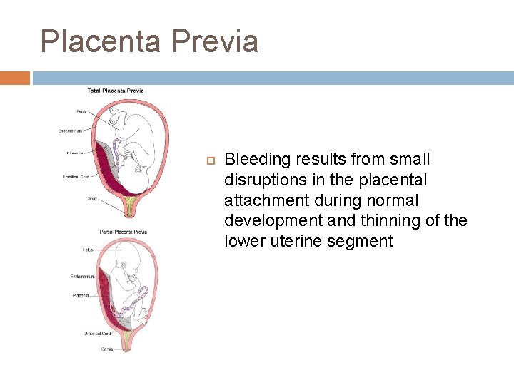 Placenta Previa Bleeding results from small disruptions in the placental attachment during normal development