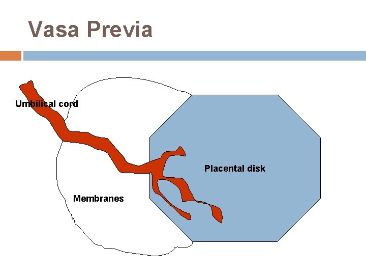 Vasa Previa Umbilical cord Placental disk Membranes 
