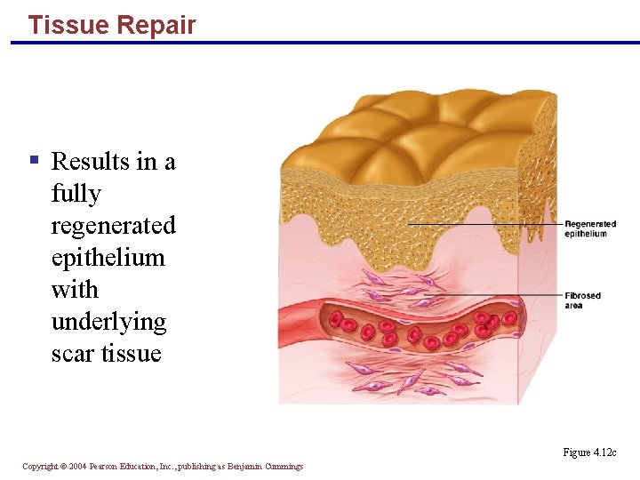 Tissue Repair § Results in a fully regenerated epithelium with underlying scar tissue Figure