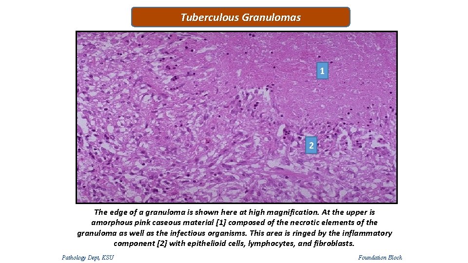 Tuberculous Granulomas 1 2 The edge of a granuloma is shown here at high Tuberculous Granulomas 1 2 The edge of a granuloma is shown here at high