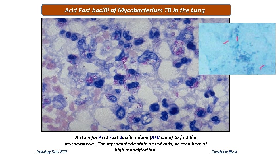 Acid Fast bacilli of Mycobacterium TB in the Lung A stain for Acid Fast Acid Fast bacilli of Mycobacterium TB in the Lung A stain for Acid Fast