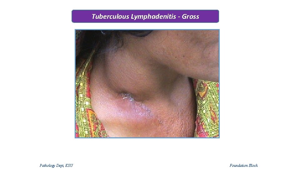 Tuberculous Lymphadenitis - Gross Pathology Dept, KSU Foundation Block Tuberculous Lymphadenitis - Gross Pathology Dept, KSU Foundation Block