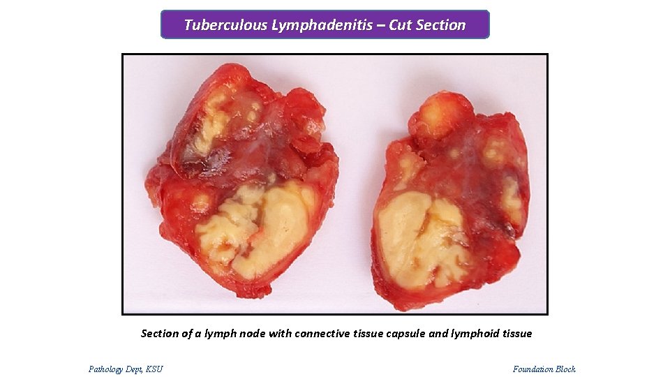 Tuberculous Lymphadenitis – Cut Section of a lymph node with connective tissue capsule and Tuberculous Lymphadenitis – Cut Section of a lymph node with connective tissue capsule and