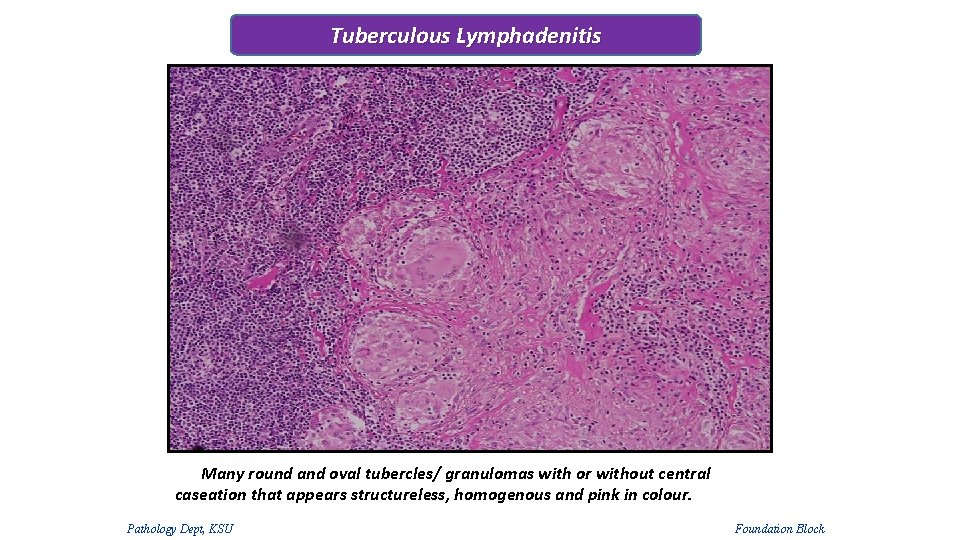 Tuberculous Lymphadenitis Many round and oval tubercles/ granulomas with or without central caseation that Tuberculous Lymphadenitis Many round and oval tubercles/ granulomas with or without central caseation that