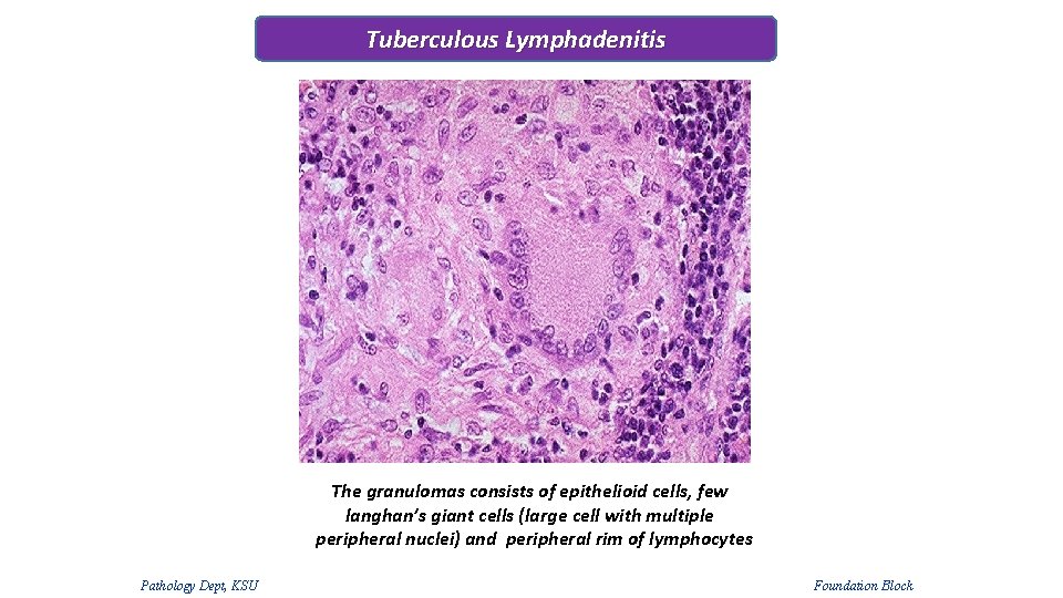 Tuberculous Lymphadenitis The granulomas consists of epithelioid cells, few langhan’s giant cells (large cell Tuberculous Lymphadenitis The granulomas consists of epithelioid cells, few langhan’s giant cells (large cell