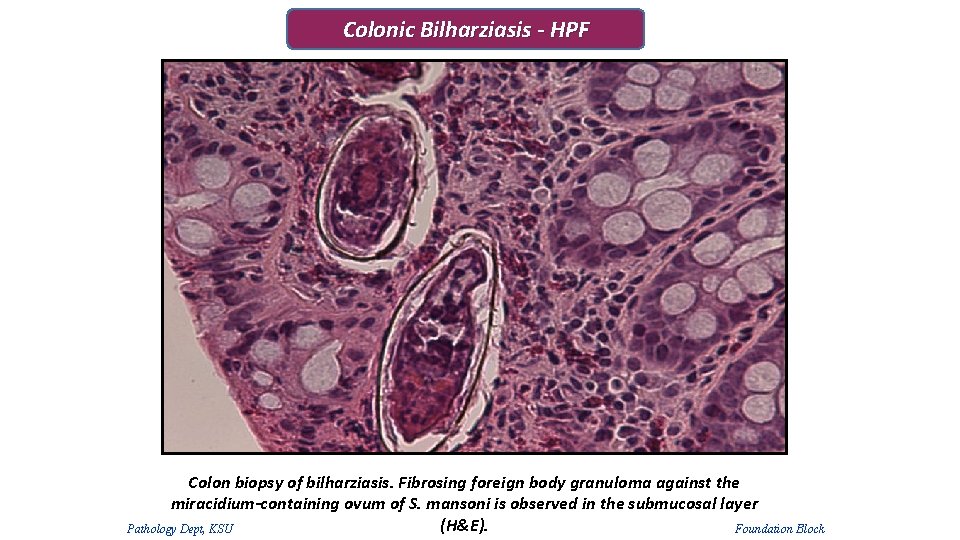 Colonic Bilharziasis - HPF Colon biopsy of bilharziasis. Fibrosing foreign body granuloma against the Colonic Bilharziasis - HPF Colon biopsy of bilharziasis. Fibrosing foreign body granuloma against the